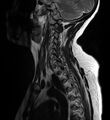 Astrocytoma - spinal cord (Radiopaedia 69769-79758 Sagittal T2 10).jpg