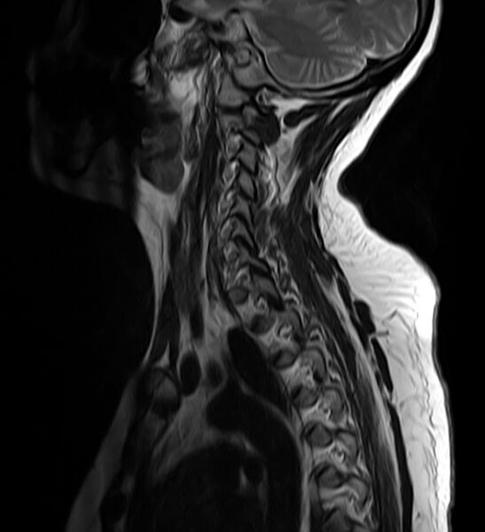 File:Astrocytoma - spinal cord (Radiopaedia 69769-79758 Sagittal T2 10).jpg