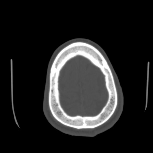 File:Asymptomatic occipital spur (Radiopaedia 87753-104201 Axial bone window 189).jpg