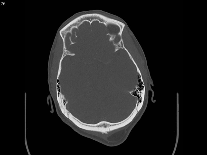 Atypical meningioma - intraosseous (Radiopaedia 64915-73867 Axial C+ bone window 26).jpg