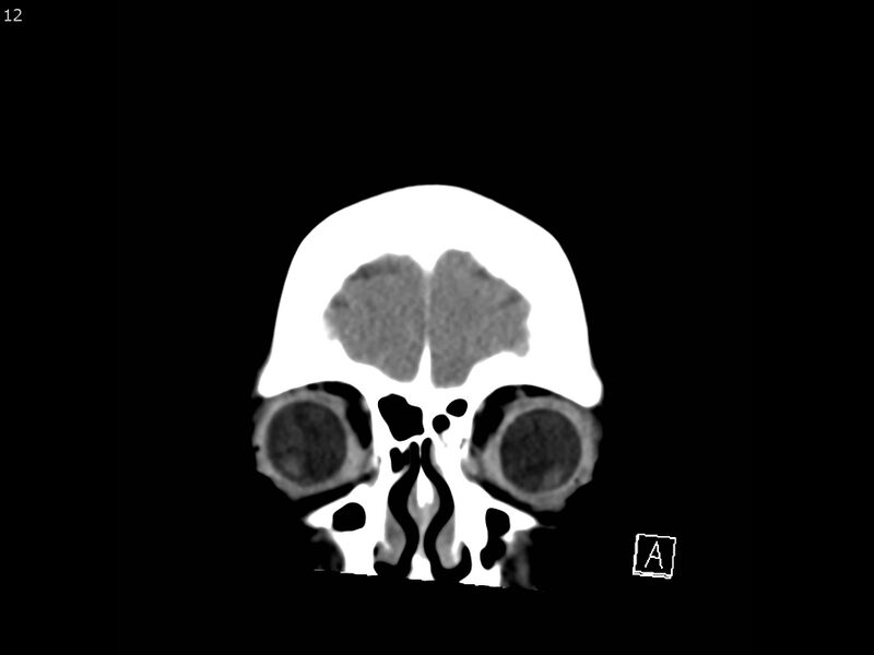 File:Atypical meningioma - intraosseous (Radiopaedia 64915-73867 B 11).jpg