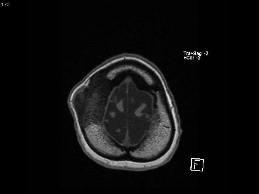 Atypical meningioma - intraosseous (Radiopaedia 64915-74572 Axial T1 170).jpg