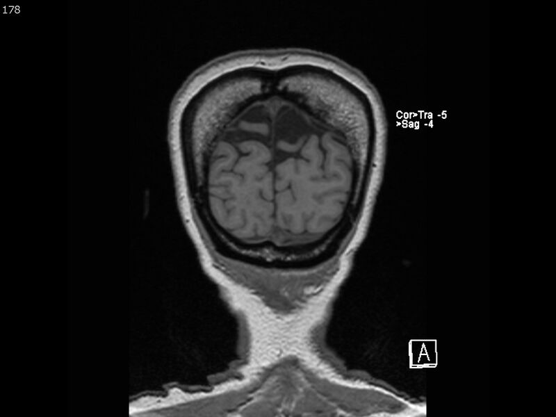File:Atypical meningioma - intraosseous (Radiopaedia 64915-74572 Coronal T1 178).jpg