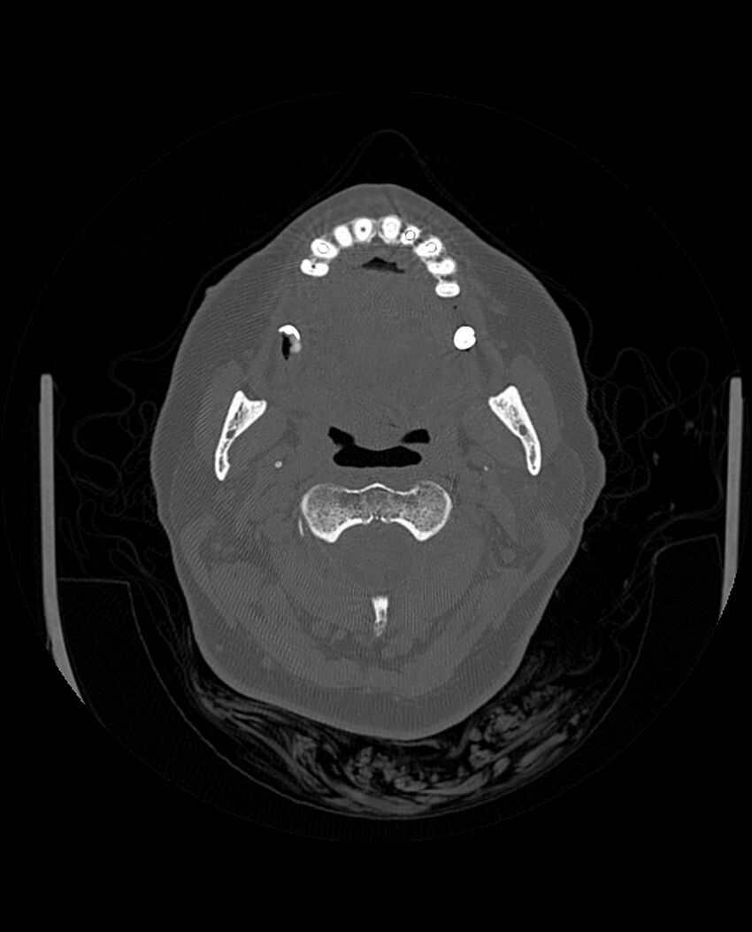 Automastoidectomy with labyrinthine fistula (Radiopaedia 84143-99411 Axial non-contrast 18).jpg