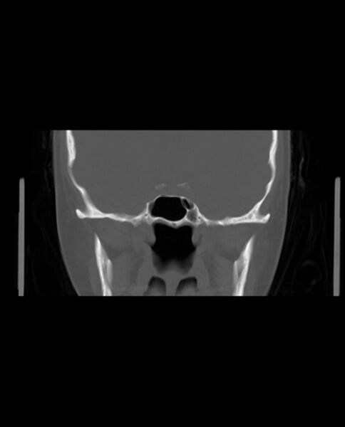 File:Automastoidectomy with labyrinthine fistula (Radiopaedia 84143-99411 Coronal non-contrast 71).jpg