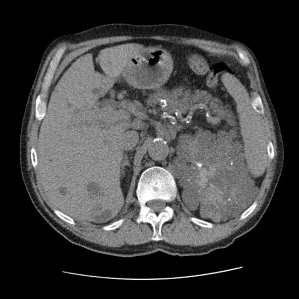 File:Autosomal dominant polycystic kidney disease (Radiopaedia 27851-28094 Axial non-contrast 58).jpg
