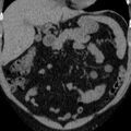 Autosomal dominant polycystic kidney disease (Radiopaedia 36539-38101 Coronal non-contrast 6).jpg