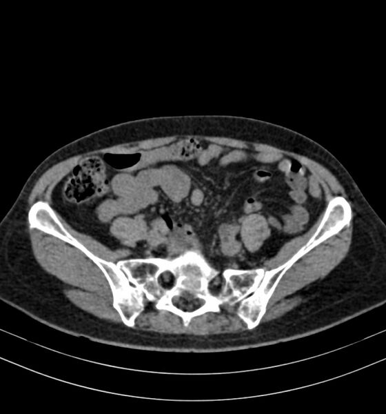 File:Autosomal dominant polycystic kidney disease (Radiopaedia 41918-44922 Axial non-contrast 25).jpg