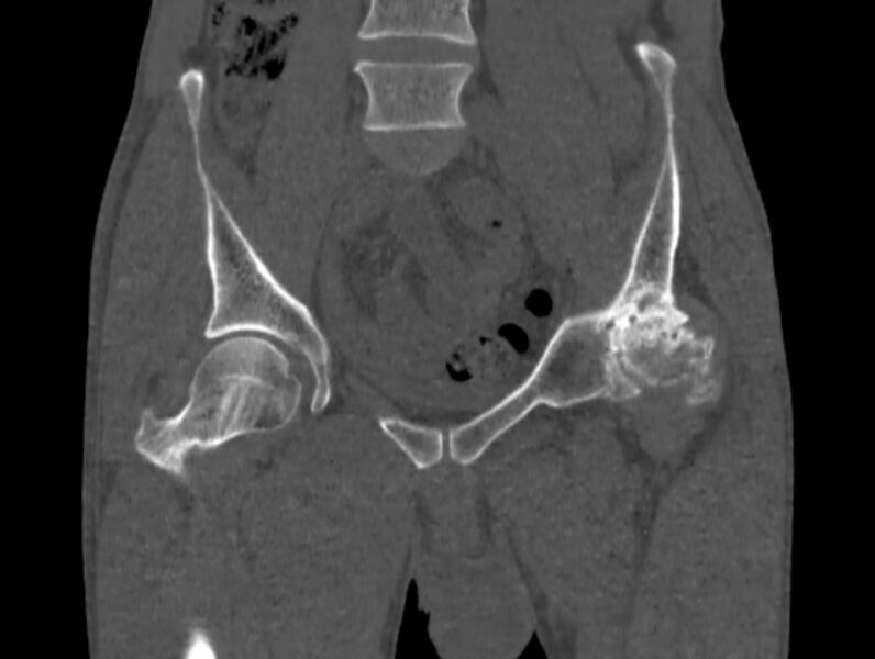 File:Avascular necrosis of the left hip (Radiopaedia 75068-86125 Coronal bone window 14).jpg