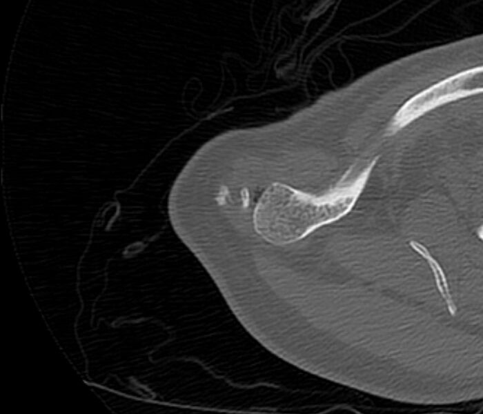 File:Avulsion fracture - greater tuberosity of humerus (Radiopaedia 71216-81514 Axial bone window 8).jpg