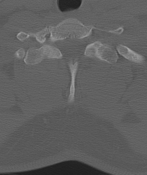 File:Axis peg fracture (type 3) and atlas lateral mass (type 4) fracture (Radiopaedia 37474-39324 Axial bone window 48).png