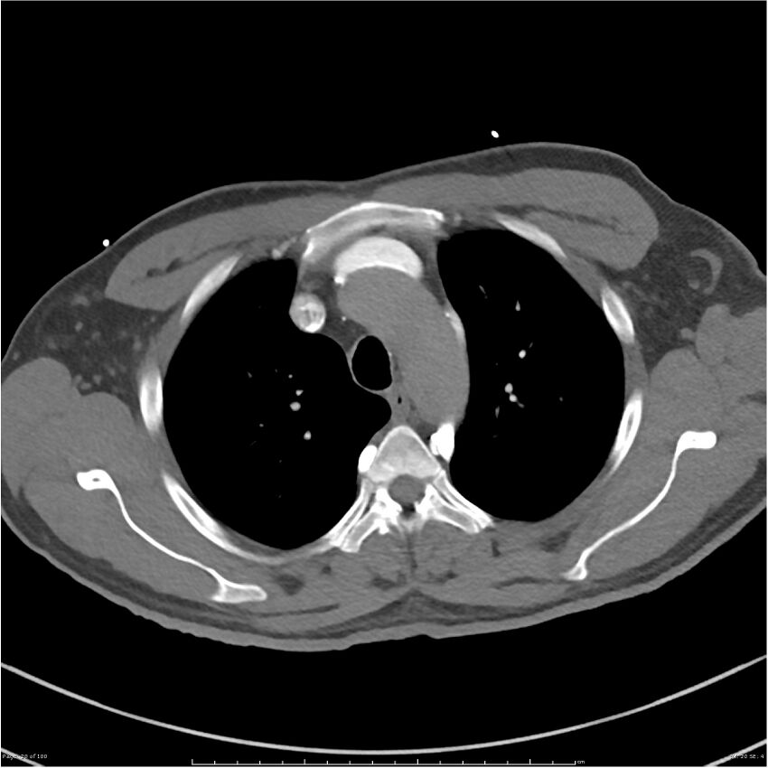 Azygos venous system anatomy (CT pulmonary angiography) (Radiopaedia 25928-26077 Axial C+ CTPA 20).jpg