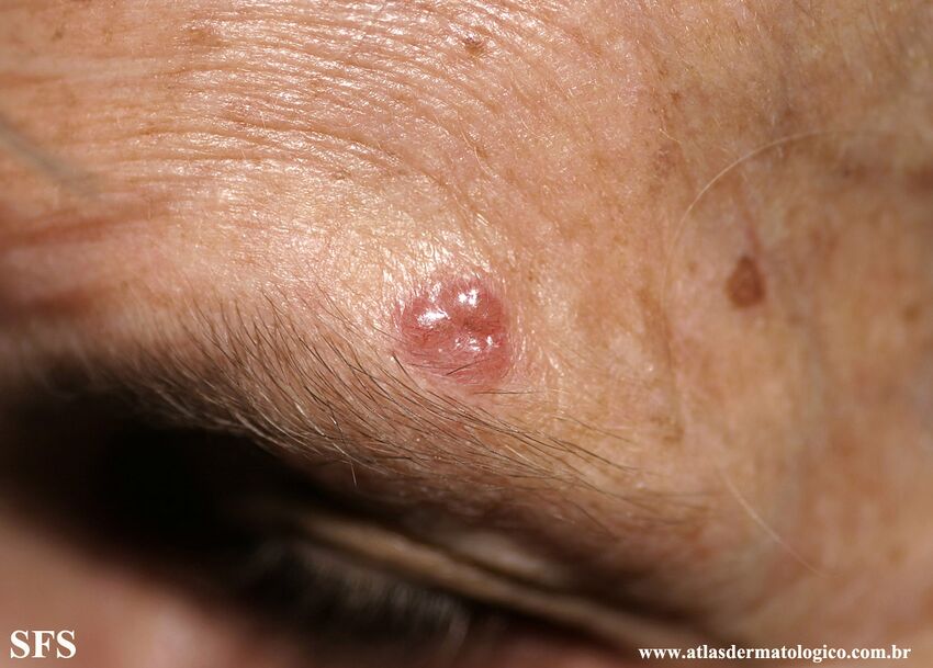 Basal Cell Carcinoma (Dermatology Atlas 315).jpg