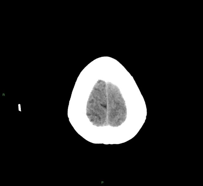 File:Basal ganglia hemorrhage (Radiopaedia 58759-65981 Axial non-contrast 7).jpg