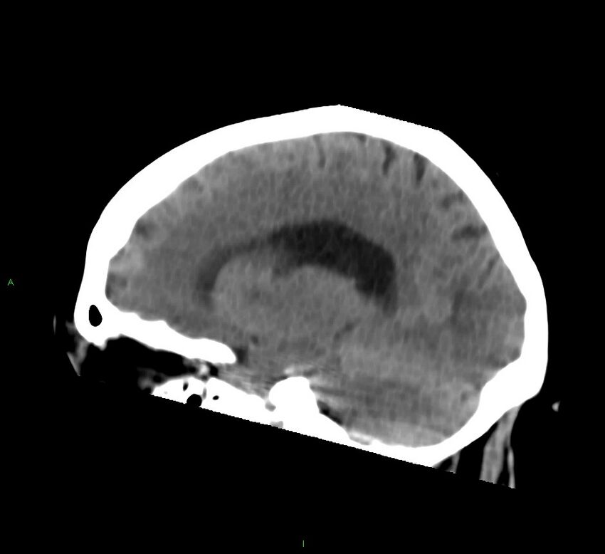 Basal ganglia hemorrhage (Radiopaedia 58759-65981 C 32).jpg
