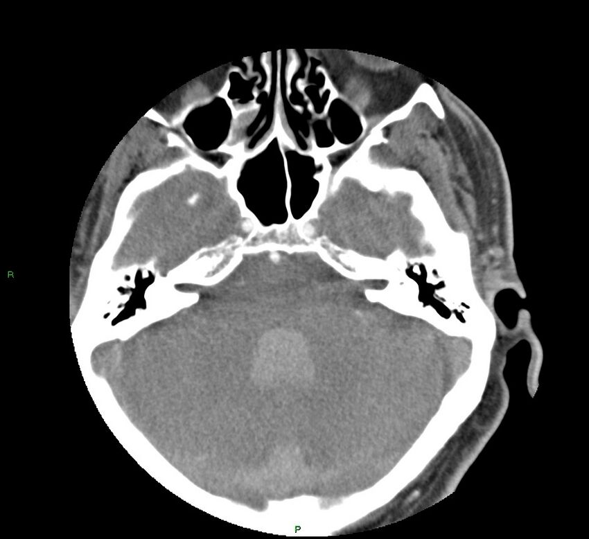 Basal ganglia hemorrhage (Radiopaedia 58763-65985 D 51).jpg