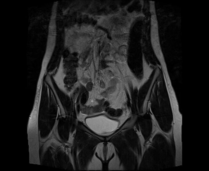 File:Bicornuate bicollis uterus (Radiopaedia 61626-69616 Coronal T2 10).jpg
