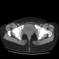 Bicornuate uterus- on MRI (Radiopaedia 49206-54296 Axial non-contrast 13).jpg