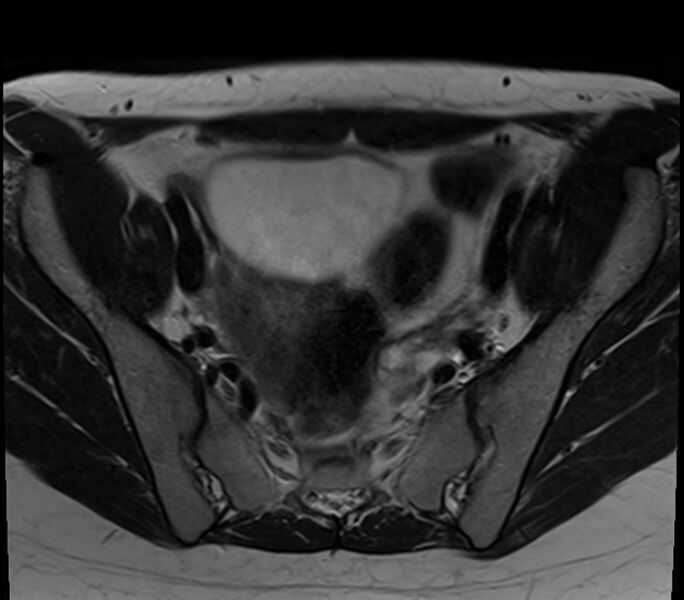 File:Bicornuate uterus (Radiopaedia 71214-81511 Axial T2 23).jpg