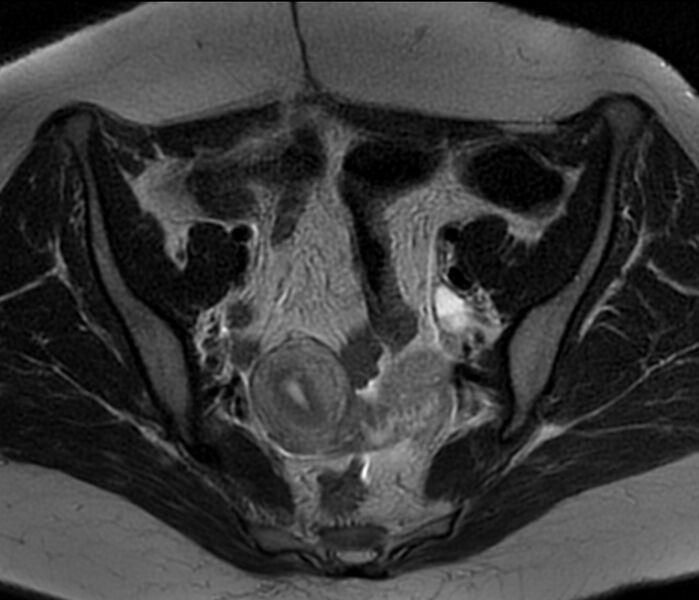 File:Bicornuate uterus (Radiopaedia 76407-88114 Axial T2 8).jpg