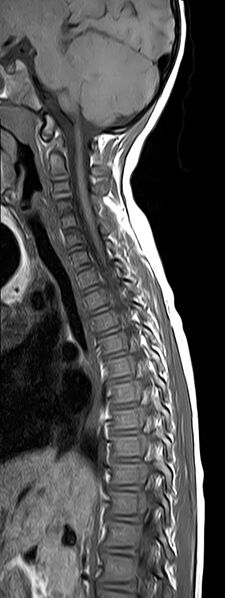 File:Bilateral Sprengel deformity with Klippel-Feil syndrome (Radiopaedia 66395-75650 Sagittal T1 5).jpg