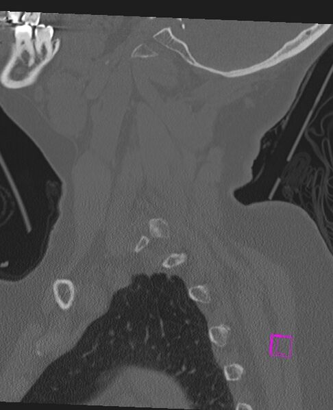 File:Bilateral atlanto-occipital assimilation (Radiopaedia 28350-28603 Sagittal bone window 18).jpg