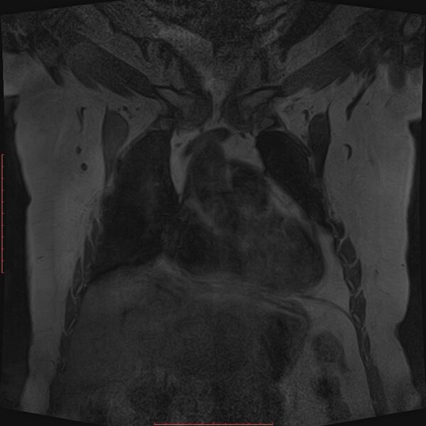 File:Bilateral breast implant rupture (Radiopaedia 24761-25027 G 1).jpg
