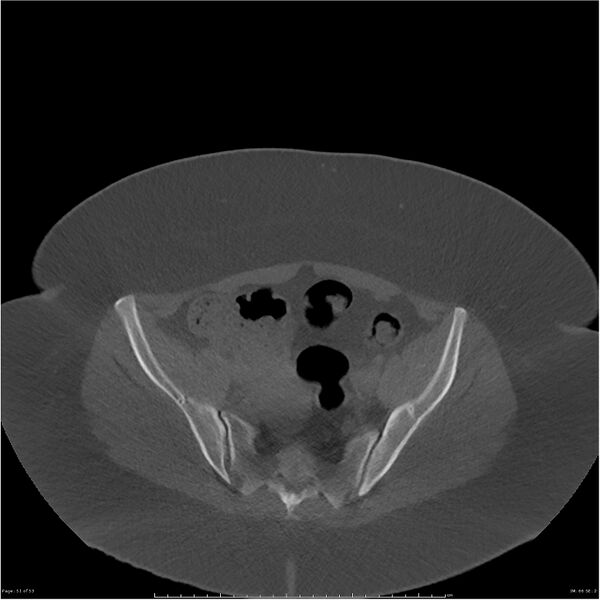 File:Bilateral lumbar ribs (Radiopaedia 25862-26010 bone window 51).jpg