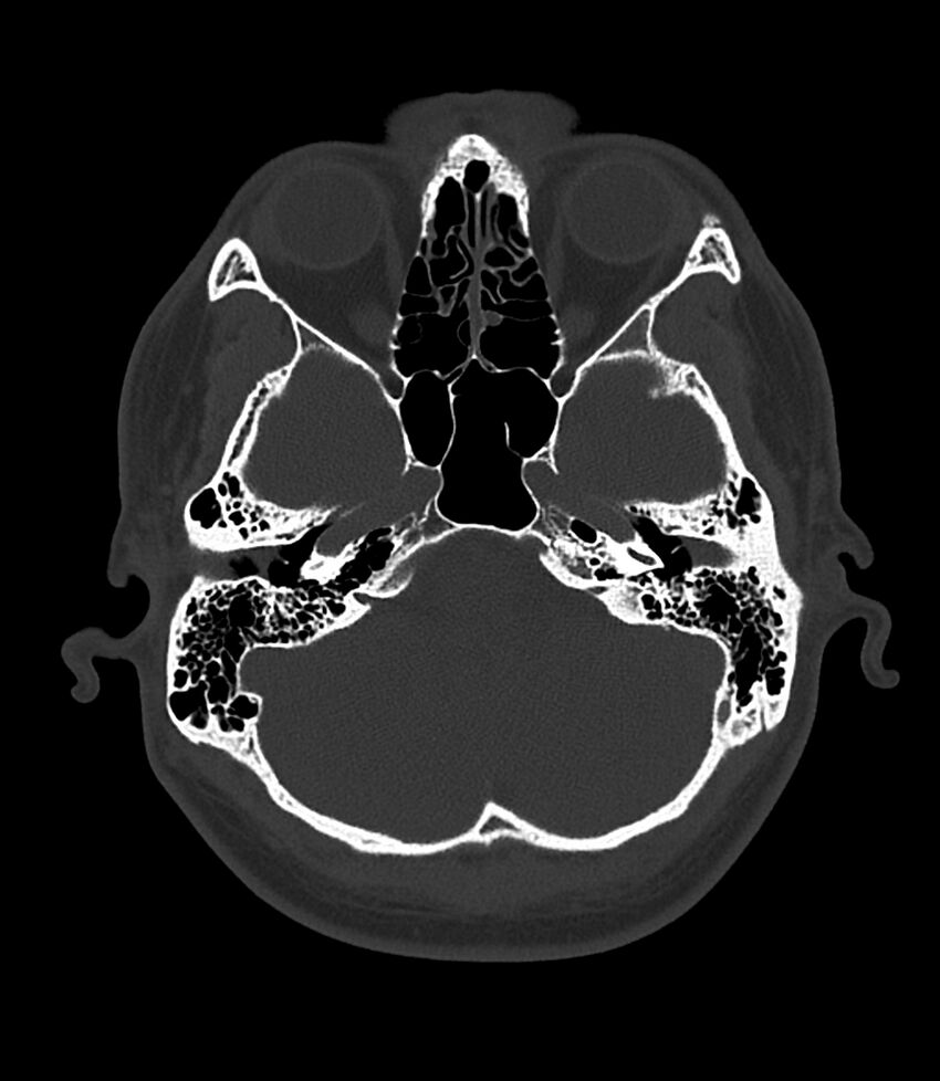 Bilateral medial canal fibrosis (Radiopaedia 85598-101344 Axial bone window 32).jpg