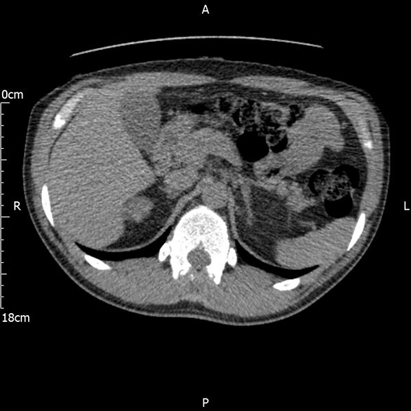 File:Bilateral medullary nephrocalcinosis with ureteric calculi (Radiopaedia 71269-81569 Axial non-contrast 29).jpg