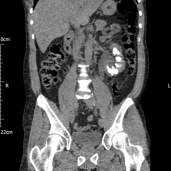 File:Bilateral medullary nephrocalcinosis with ureteric calculi (Radiopaedia 71269-81569 Coronal non-contrast 35).jpg