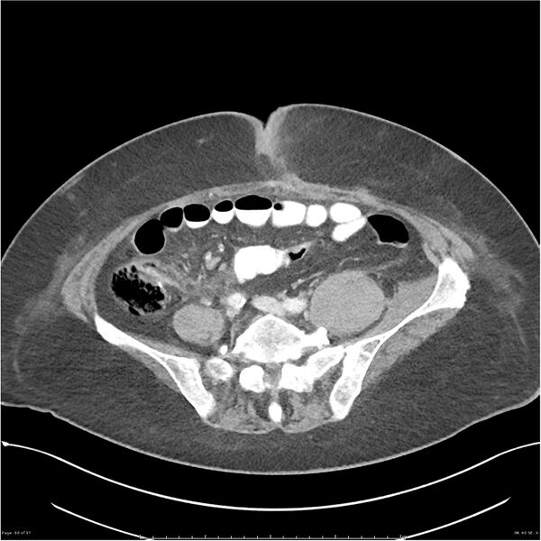 File:Bilateral psoas hematomas (Radiopaedia 24057-24279 A 60).jpg