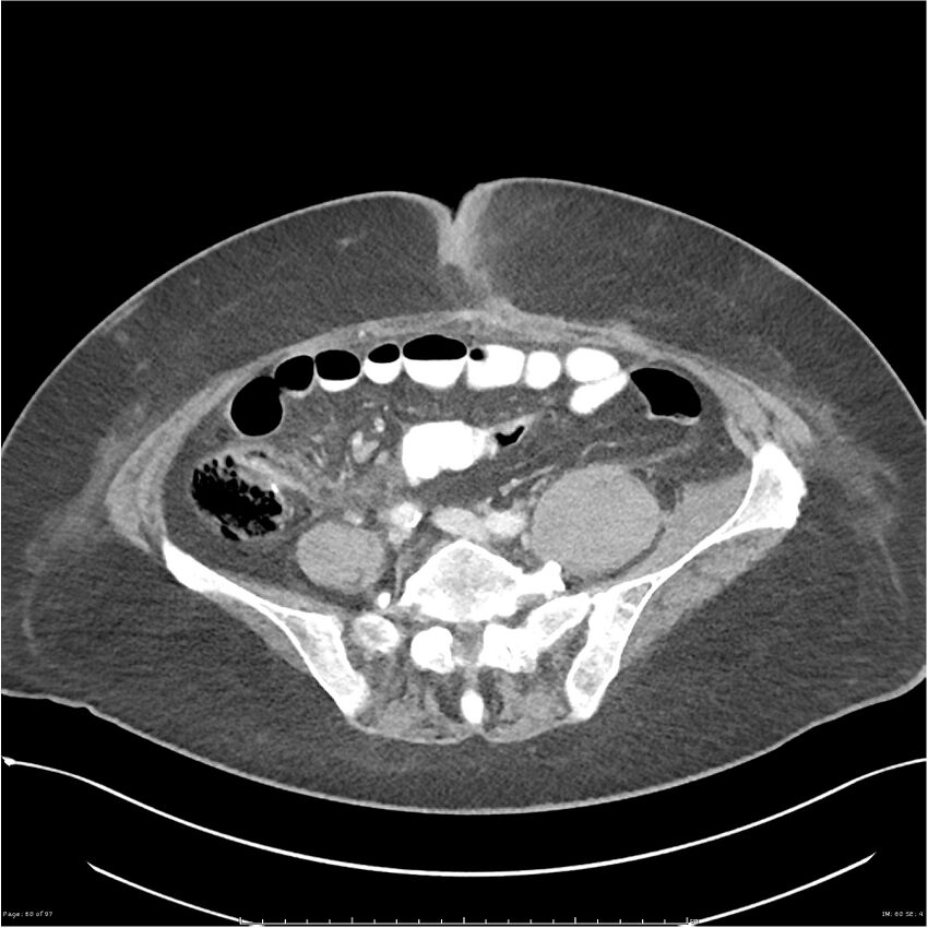 Bilateral psoas hematomas (Radiopaedia 24057-24279 A 60).jpg