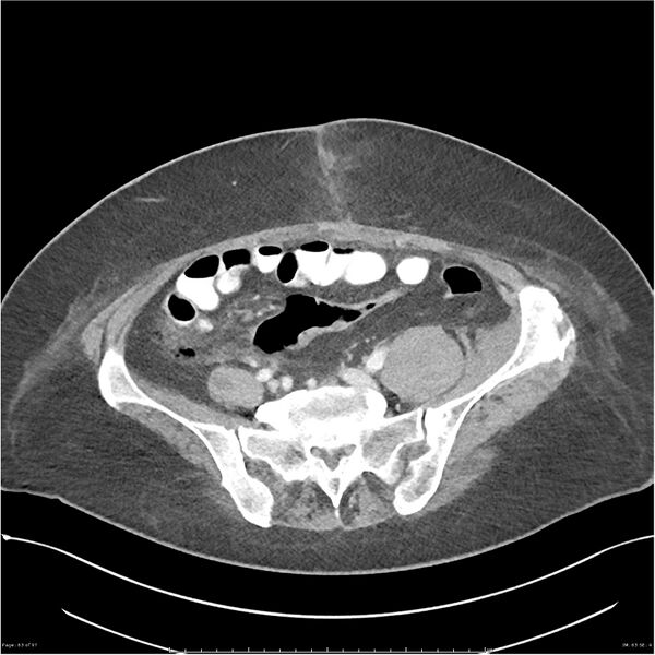 File:Bilateral psoas hematomas (Radiopaedia 24057-24279 A 63).jpg