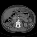 Biliary necrosis - liver transplant (Radiopaedia 21876-21846 A 33).jpg