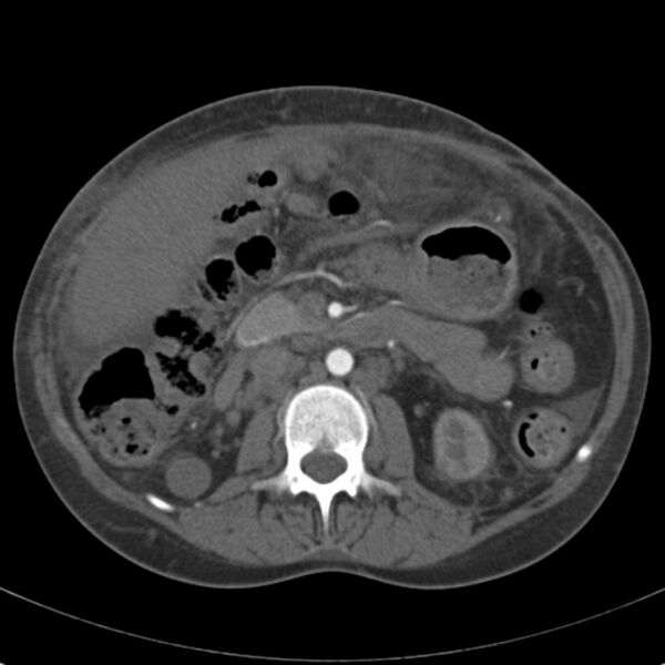 File:Biliary necrosis - liver transplant (Radiopaedia 21876-21846 A 33).jpg