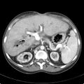 Biliary necrosis - liver transplant (Radiopaedia 21876-21846 B 23).jpg