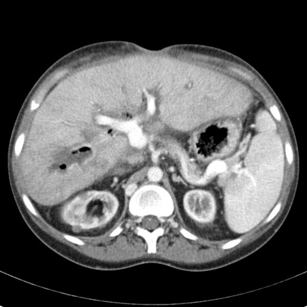File:Biliary necrosis - liver transplant (Radiopaedia 21876-21846 B 23).jpg