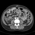 Biliary necrosis - liver transplant (Radiopaedia 21876-21846 B 43).jpg