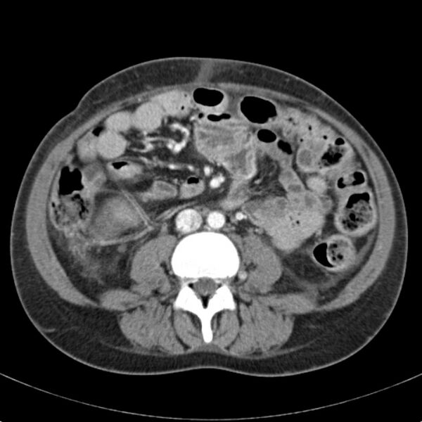 File:Biliary necrosis - liver transplant (Radiopaedia 21876-21846 B 43).jpg