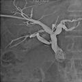 Biliary stenting - lower CBD cholangiocarcinoma (Radiopaedia 10811-11255 A 1).jpg