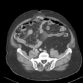 Bladder papillary urothelial carcinoma (Radiopaedia 48119-52951 Axial 39).png