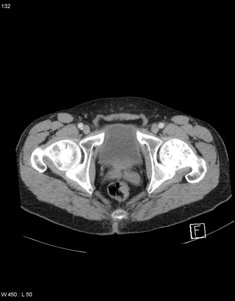 File:Boerhaave syndrome with tension pneumothorax (Radiopaedia 56794-63603 A 66).jpg
