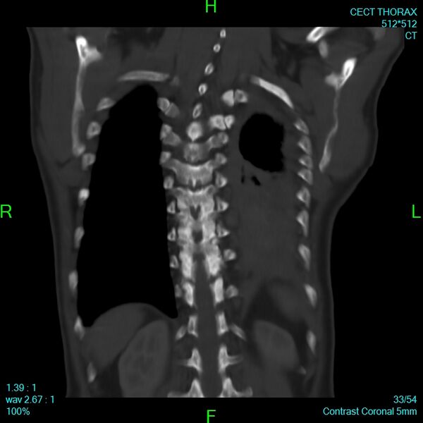 File:Bone metastases from lung carcinoma (Radiopaedia 54703-60937 Coronal bone window 33).jpg