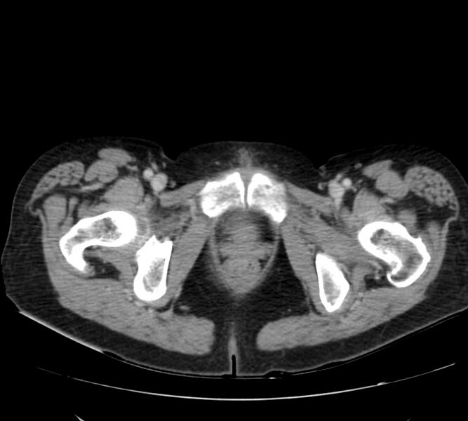 File:Bosniak renal cyst - type IV (Radiopaedia 22929-22953 C 69).jpg