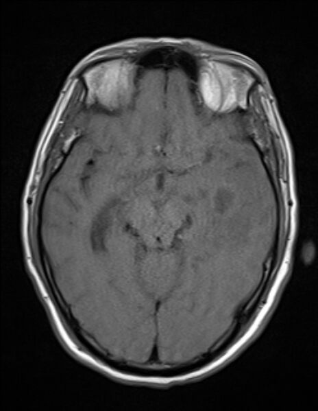 File:Brain abscess with ventriculitis (Radiopaedia 85703-101495 Axial T1 11).jpg