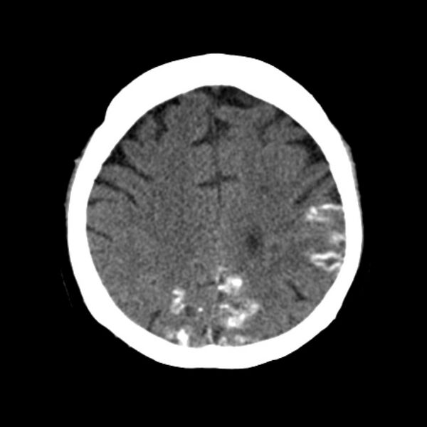 File:Brain cortical laminar necrosis (Radiopaedia 25822-25971 Axial non-contrast 32).jpg