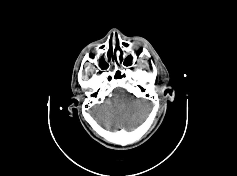 File:Brain injury by firearm projectile (Radiopaedia 82068-96087 B 62).jpg