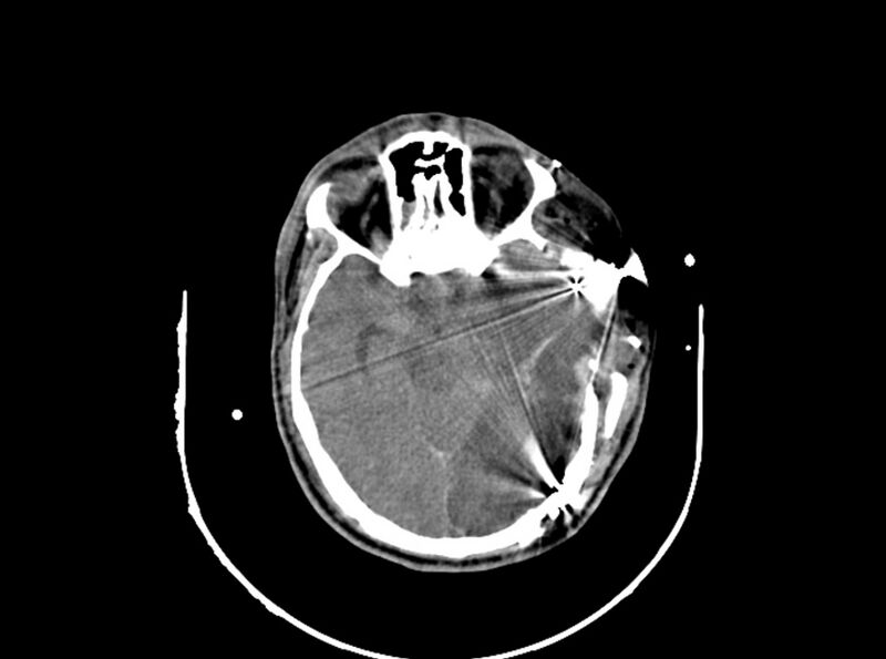 File:Brain injury by firearm projectile (Radiopaedia 82068-96087 B 88).jpg