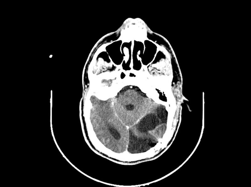 File:Brain injury by firearm projectile (Radiopaedia 82068-96088 B 95).jpg